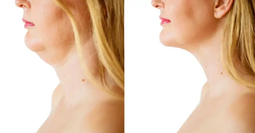 HIFU for Double Chin Removal