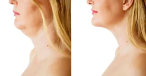 HIFU for Double Chin Removal – Does It Really Work?