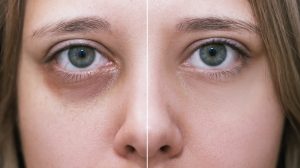 Under-Eye Fillers: Best Solution for Dark Circles