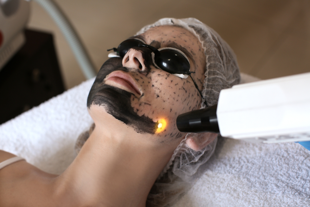 Carbon Laser Peel treatment