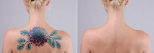 Does Pico Laser Tattoo Removal Leave Scars?