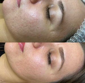 Carbon Laser Peel for Bacne (Back Acne) and Body Scarring