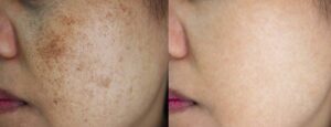 Melasma Treatment