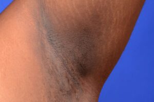 Detanning Treatment for Dark Underarms