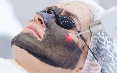 Carbon laser peel