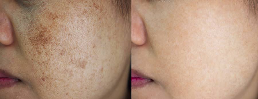Melasma Treatment