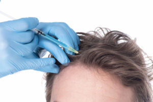 How Many GFC Sessions Are Required for Hair Regrowth?