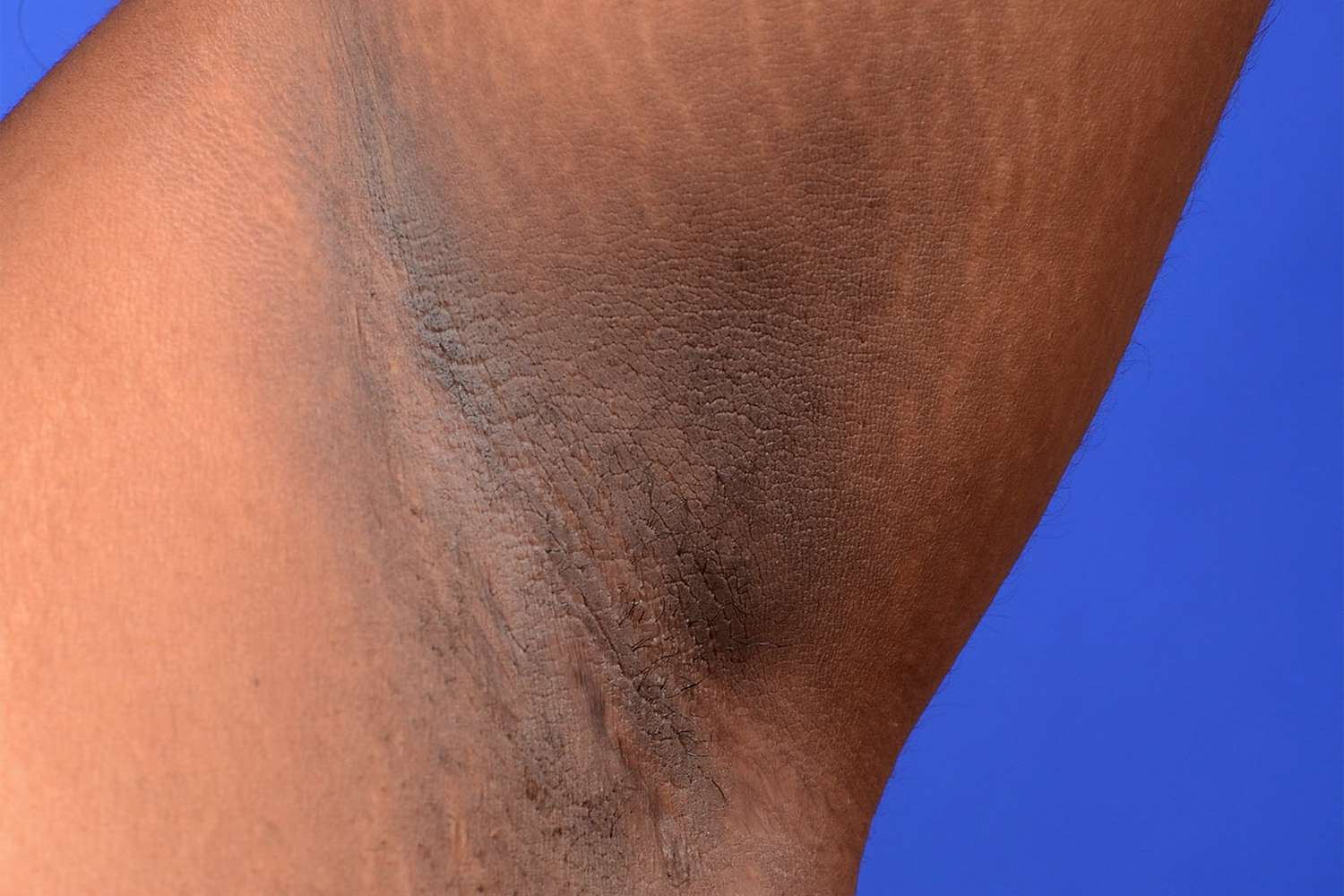 Detanning Treatment for Dark Underarms