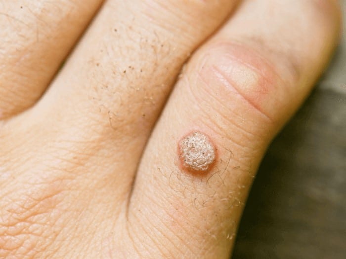 warts removal