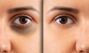 Dark Circles Due to Stress & Lack of Sleep – What Actually Works?