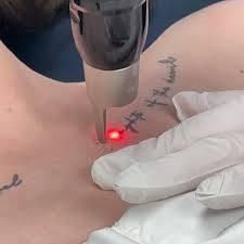 Pico Laser Tattoo Removal