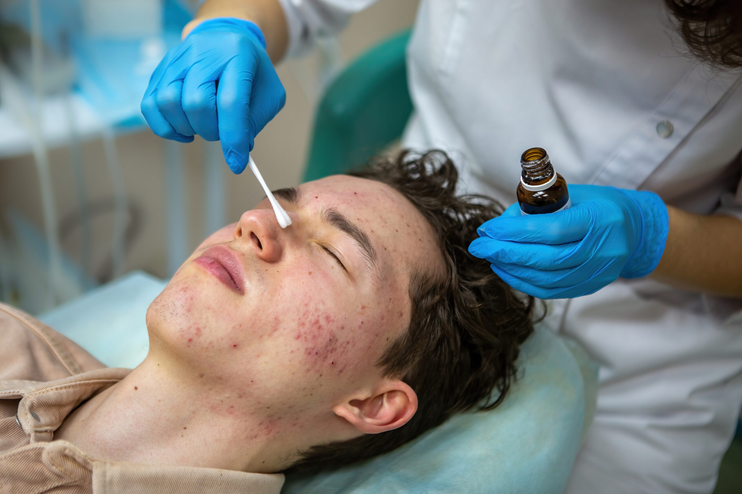 Acne Scar Treatment in Bangalore